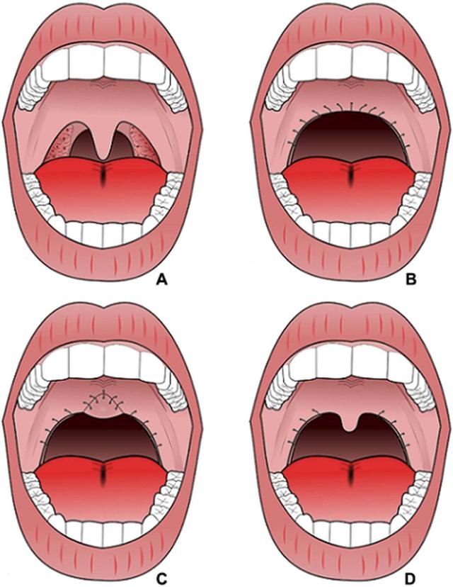 建议我进行一种手术,悬雍垂腭咽成形术(uvulopalatopharyngoplasty